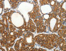SLC12A4 / KCC1 Antibody - Immunohistochemistry of paraffin-embedded Human colon cancer using SLC12A4 Polyclonal Antibody at dilution of 1:30.