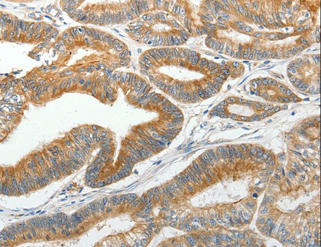 SLC12A4 / KCC1 Antibody - Immunohistochemistry of paraffin-embedded Human colon cancer using SLC12A4 Polyclonal Antibody at dilution of 1:30.