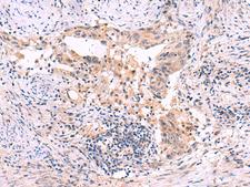 SLC12A5 / KCC2 Antibody - Immunohistochemistry of paraffin-embedded Human cervical cancer tissue  using SLC12A5 Polyclonal Antibody at dilution of 1:40(×200)
