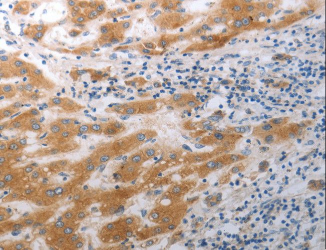 SLC12A6 / KCC3 Antibody - Immunohistochemistry of paraffin-embedded Human liver cancer using SLC12A6 Polyclonal Antibody at dilution of 1:40.