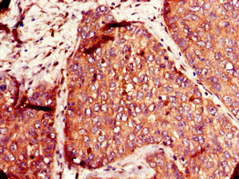 SLC12A7 / KCC4 Antibody - Immunohistochemistry of paraffin-embedded human ovarian cancer at dilution of 1:100