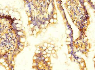 SLC13A2 / NaCT Antibody - Immunohistochemistry of paraffin-embedded human colon cancer at dilution 1:100