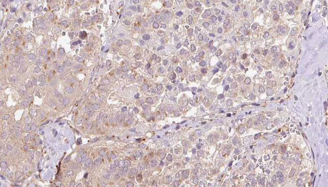 SLC13A2 / NaCT Antibody - 1:100 staining human thyroid carcinoma tissue by IHC-P. The sample was formaldehyde fixed and a heat mediated antigen retrieval step in citrate buffer was performed. The sample was then blocked and incubated with the antibody for 1.5 hours at 22°C. An HRP conjugated goat anti-rabbit antibody was used as the secondary.