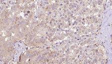 SLC13A2 / NaCT Antibody - 1:100 staining human thyroid carcinoma tissue by IHC-P. The sample was formaldehyde fixed and a heat mediated antigen retrieval step in citrate buffer was performed. The sample was then blocked and incubated with the antibody for 1.5 hours at 22°C. An HRP conjugated goat anti-rabbit antibody was used as the secondary.