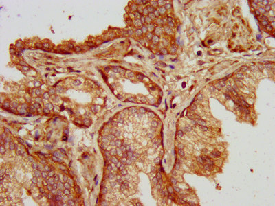 SLC14A1 / JK Antibody - Immunohistochemistry image at a dilution of 1:200 and staining in paraffin-embedded human prostate cancer performed on a Leica BondTM system. After dewaxing and hydration, antigen retrieval was mediated by high pressure in a citrate buffer (pH 6.0) . Section was blocked with 10% normal goat serum 30min at RT. Then primary antibody (1% BSA) was incubated at 4 °C overnight. The primary is detected by a biotinylated secondary antibody and visualized using an HRP conjugated SP system.