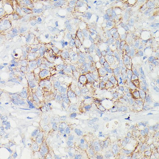 SLC14A1 / JK Antibody - Immunohistochemistry of paraffin-embedded Human lymph node tumors using SLC14A1 Polyclonal Antibody at dilution of 1:100 (40x lens).