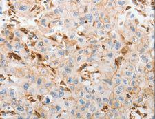 SLC15A2 / PEPT2 Antibody - Immunohistochemistry of paraffin-embedded Human lung cancer using SLC15A2 Polyclonal Antibody at dilution of 1:60.