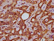 SLC15A4 / PHT1 Antibody - Immunohistochemistry Dilution at 1:200 and staining in paraffin-embedded human liver cancer performed on a Leica BondTM system. After dewaxing and hydration, antigen retrieval was mediated by high pressure in a citrate buffer (pH 6.0). Section was blocked with 10% normal Goat serum 30min at RT. Then primary antibody (1% BSA) was incubated at 4°C overnight. The primary is detected by a biotinylated Secondary antibody and visualized using an HRP conjugated SP system.