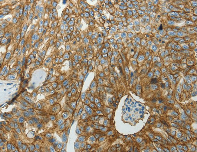 SLC16A1 / MCT1 Antibody - Immunohistochemistry of paraffin-embedded Human ovarian cancer using SLC16A1 Polyclonal Antibody at dilution of 1:50.