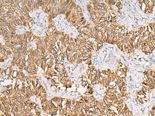 SLC16A1 / MCT1 Antibody - Immunohistochemistry of paraffin-embedded Human ovarian cancer tissue  using SLC16A1 Polyclonal Antibody at dilution of 1:30(×200)