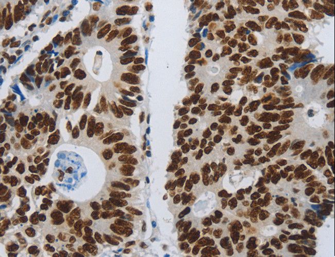 SLC16A14 / MCT14 Antibody - Immunohistochemistry of paraffin-embedded Human ovarian cancer using SLC16A14 Polyclonal Antibody at dilution of 1:80.