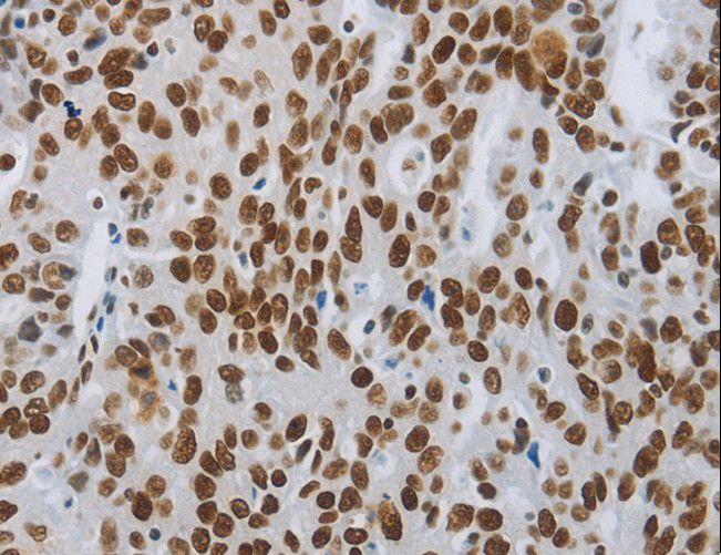 SLC16A14 / MCT14 Antibody - Immunohistochemistry of paraffin-embedded Human ovarian cancer using SLC16A14 Polyclonal Antibody at dilution of 1:80.