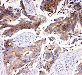 SLC16A4 Antibody - SLC16A4 / MCT4 antibody. IHC(P): Human Breast Cancer Tissue.