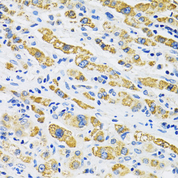 SLC16A4 Antibody - Immunohistochemistry of paraffin-embedded human liver cancer using SLC16A4 antibody at dilution of 1:100 (40x lens).