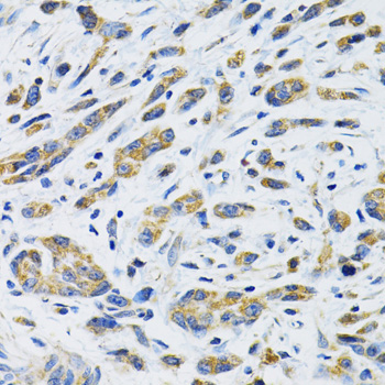 SLC16A4 Antibody - Immunohistochemistry of paraffin-embedded human gastric cancer using SLC16A4 antibody at dilution of 1:100 (40x lens).