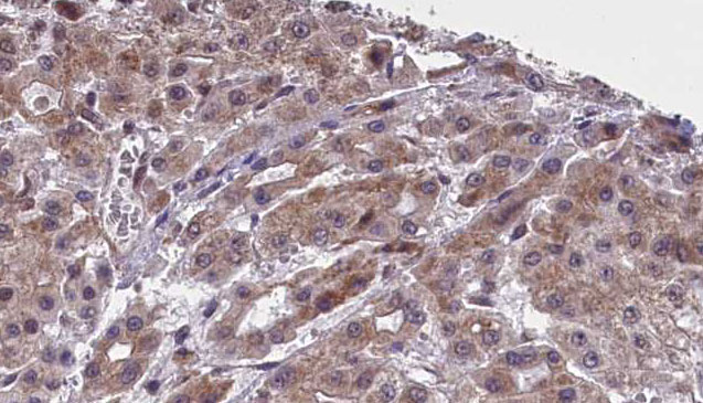 SLC16A4 Antibody - 1:100 staining human liver carcinoma tissues by IHC-P. The sample was formaldehyde fixed and a heat mediated antigen retrieval step in citrate buffer was performed. The sample was then blocked and incubated with the antibody for 1.5 hours at 22°C. An HRP conjugated goat anti-rabbit antibody was used as the secondary.