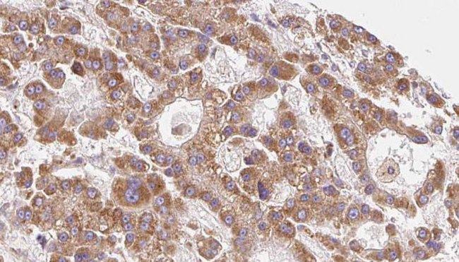 SLC16A6 / MCT6 Antibody - 1:100 staining human liver carcinoma tissues by IHC-P. The sample was formaldehyde fixed and a heat mediated antigen retrieval step in citrate buffer was performed. The sample was then blocked and incubated with the antibody for 1.5 hours at 22°C. An HRP conjugated goat anti-rabbit antibody was used as the secondary.