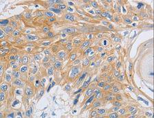 SLC16A7 / MCT2 Antibody - Immunohistochemistry of paraffin-embedded Human esophagus cancer using SLC16A7 Polyclonal Antibody at dilution of 1:30.