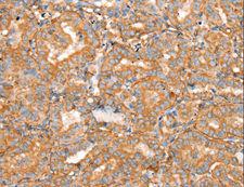SLC16A8 Antibody - Immunohistochemistry of paraffin-embedded Human thyroid cancer using SLC16A8 Polyclonal Antibody at dilution of 1:40.