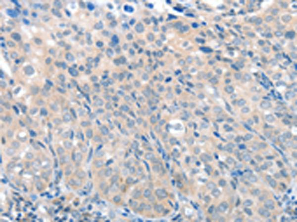 SLC17A6 / VGLUT2 Antibody - Immunohistochemistry of paraffin-embedded Human cervical cancer tissue  using SLC17A6 Polyclonal Antibody at dilution of 1:100(×200)