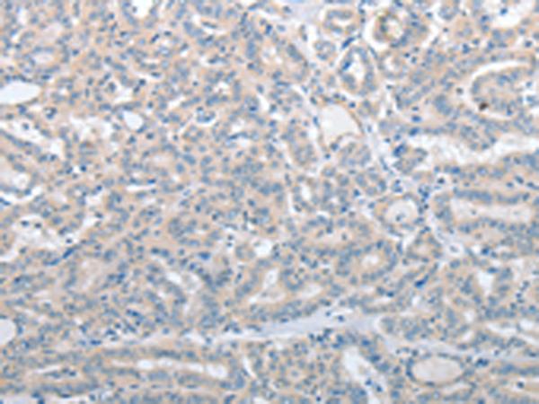 SLC17A6 / VGLUT2 Antibody - Immunohistochemistry of paraffin-embedded Human thyroid cancer tissue  using SLC17A6 Polyclonal Antibody at dilution of 1:100(×200)