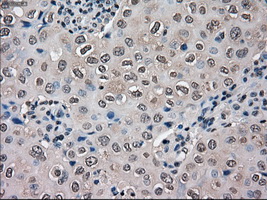 SLC18A2 / VMAT2 Antibody - IHC of paraffin-embedded Adenocarcinoma of breast tissue using anti-SLC18A2 mouse monoclonal antibody. (Dilution 1:50).
