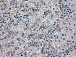 SLC18A2 / VMAT2 Antibody - IHC of paraffin-embedded Carcinoma of kidney tissue using anti-SLC18A2 mouse monoclonal antibody. (Dilution 1:50).