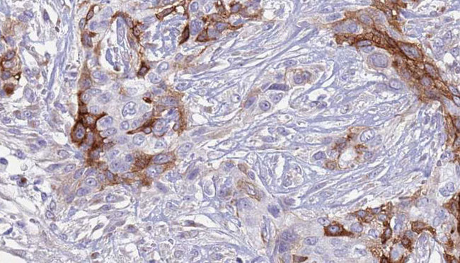 SLC18A2 / VMAT2 Antibody - 1:100 staining human urothelial carcinoma tissue by IHC-P. The sample was formaldehyde fixed and a heat mediated antigen retrieval step in citrate buffer was performed. The sample was then blocked and incubated with the antibody for 1.5 hours at 22°C. An HRP conjugated goat anti-rabbit antibody was used as the secondary.