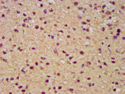 SLC19A2 / TC1 Antibody - Immunohistochemistry image at a dilution of 1:300 and staining in paraffin-embedded human glioma cancer performed on a Leica BondTM system. After dewaxing and hydration, antigen retrieval was mediated by high pressure in a citrate buffer (pH 6.0) . Section was blocked with 10% normal goat serum 30min at RT. Then primary antibody (1% BSA) was incubated at 4 °C overnight. The primary is detected by a biotinylated secondary antibody and visualized using an HRP conjugated SP system.
