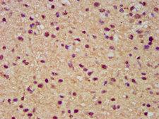 SLC19A2 / TC1 Antibody - Immunohistochemistry image at a dilution of 1:300 and staining in paraffin-embedded human glioma cancer performed on a Leica BondTM system. After dewaxing and hydration, antigen retrieval was mediated by high pressure in a citrate buffer (pH 6.0) . Section was blocked with 10% normal goat serum 30min at RT. Then primary antibody (1% BSA) was incubated at 4 °C overnight. The primary is detected by a biotinylated secondary antibody and visualized using an HRP conjugated SP system.
