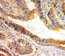 SLC1A4 / ASCT1 Antibody - SLC1A4 / ASCT1 antibody. IHC(P): Human Intestinal Cancer Tissue.
