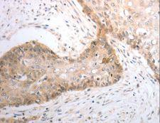 SLC1A4 / ASCT1 Antibody - Immunohistochemistry of paraffin-embedded Human cervical cancer using SLC1A4 Polyclonal Antibody at dilution of 1:40.