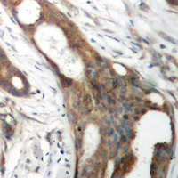 SLC1A4 / ASCT1 Antibody - Immunohistochemical analysis of ASCT1 staining in human ovarian cancer formalin fixed paraffin embedded tissue section. The section was pre-treated using heat mediated antigen retrieval with sodium citrate buffer (pH 6.0). The section was then incubated with the antibody at room temperature and detected using an HRP conjugated compact polymer system. DAB was used as the chromogen. The section was then counterstained with hematoxylin and mounted with DPX.