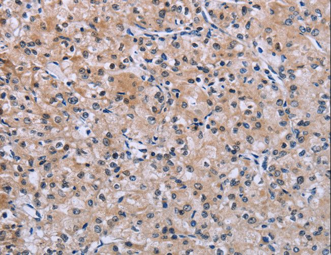 SLC1A6 / EAAT4 Antibody - Immunohistochemistry of paraffin-embedded Human prostate cancer using SLC1A6 Polyclonal Antibody at dilution of 1:40.