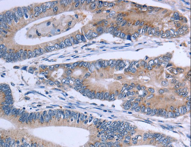 SLC1A6 / EAAT4 Antibody - Immunohistochemistry of paraffin-embedded Human colon cancer using SLC1A6 Polyclonal Antibody at dilution of 1:40.