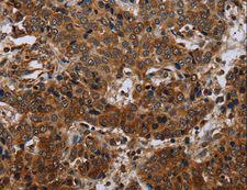 SLC1A6 / EAAT4 Antibody - Immunohistochemistry of paraffin-embedded Human liver cancer using SLC1A6 Polyclonal Antibody at dilution of 1:40.