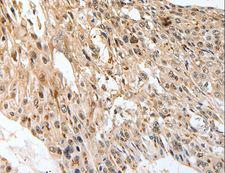 SLC1A7 / EAAT5 Antibody - Immunohistochemistry of paraffin-embedded Human esophagus cancer using SLC1A7 Polyclonal Antibody at dilution of 1:60.