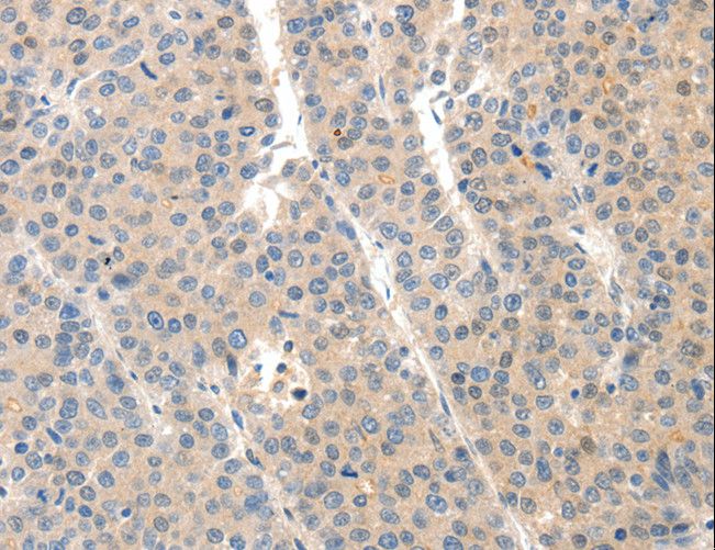 SLC20A1 Antibody - Immunohistochemistry of paraffin-embedded Human ovarian cancer using SLC20A1 Polyclonal Antibody at dilution of 1:40.