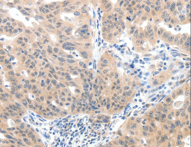 SLC20A1 Antibody - Immunohistochemistry of paraffin-embedded Human ovarian cancer using SLC20A1 Polyclonal Antibody at dilution of 1:40.