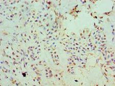 SLC20A2 / PIT2 Antibody - Immunohistochemistry of paraffin-embedded human breast cancer using antibody at 1:100 dilution.