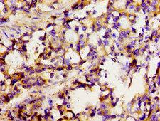 SLC22A1 Antibody - Immunohistochemistry image of paraffin-embedded human gastric cancer at a dilution of 1:100