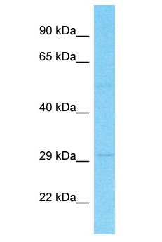 SLC22A15 / FLIPT1 Antibody - SLC22A15 / FLIPT1 antibody Western Blot of Stomach Tumor. Antibody dilution: 1 ug/ml.  This image was taken for the unconjugated form of this product. Other forms have not been tested.