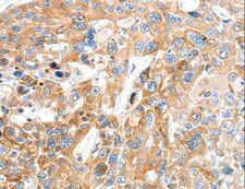 SLC22A17 Antibody - Immunohistochemistry of paraffin-embedded Human esophagus cancer using SLC22A17 Polyclonal Antibody at dilution of 1:30.