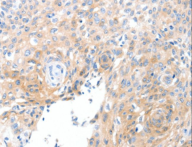 SLC22A17 Antibody - Immunohistochemistry of paraffin-embedded Human cervical cancer using SLC22A17 Polyclonal Antibody at dilution of 1:30.