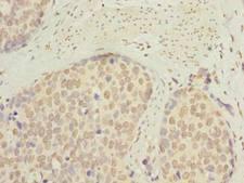 SLC22A18AS Antibody - Immunohistochemistry of paraffin-embedded human gastric cancer using antibody at dilution of 1:100.