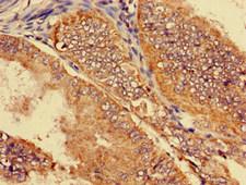 SLC22A2 Antibody - Immunohistochemistry image of paraffin-embedded human endometrial cancer at a dilution of 1:100