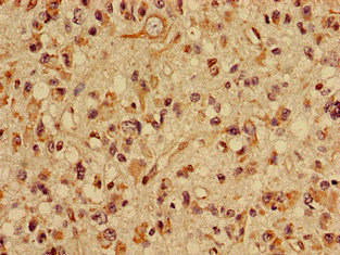 SLC22A2 Antibody - Immunohistochemistry image of paraffin-embedded human glioma cancer at a dilution of 1:100