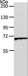 SLC22A3 / OCT3 Antibody - Western blot analysis of Human liver cancer tissue, using SLC22A3 Polyclonal Antibody at dilution of 1:600.