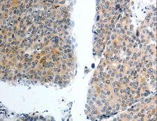 SLC22A3 / OCT3 Antibody - Immunohistochemistry of paraffin-embedded Human liver cancer using SLC22A3 Polyclonal Antibody at dilution of 1:40.