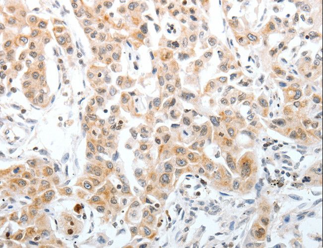 SLC22A3 / OCT3 Antibody - Immunohistochemistry of paraffin-embedded Human lung cancer using SLC22A3 Polyclonal Antibody at dilution of 1:40.